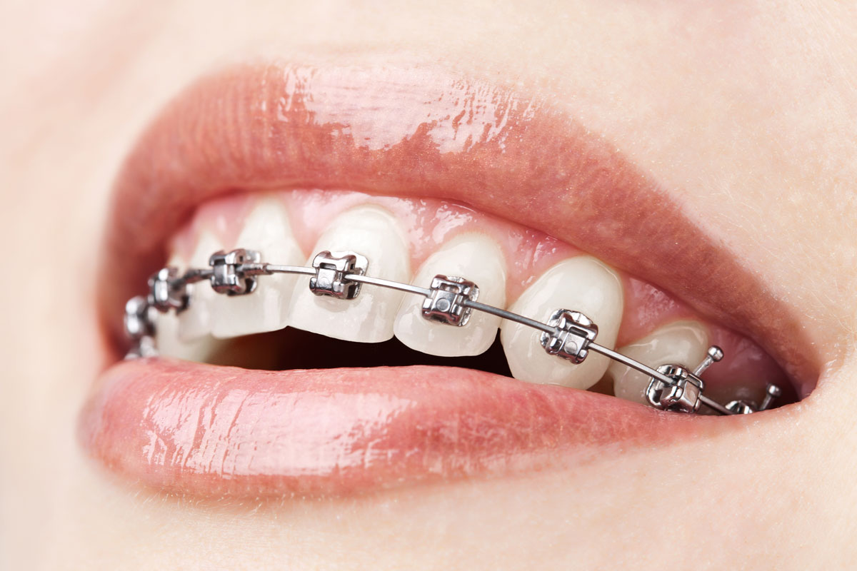 Ortodoncia. Clinica dental Tellechea